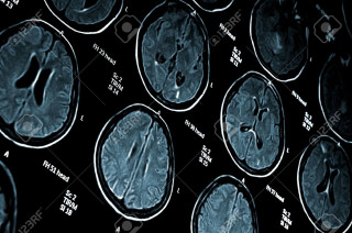 Mri brain anatomy neoplasticism stockphoto - neoplasticism free wallpaper for desktop